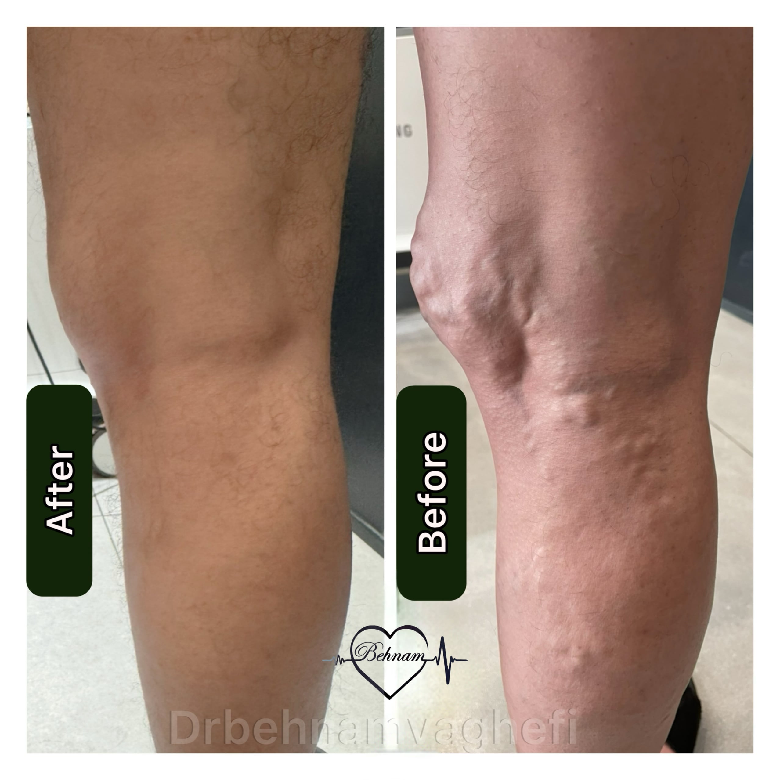 Varicoseveinsinthethigh