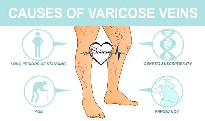 Causes of varicose veins