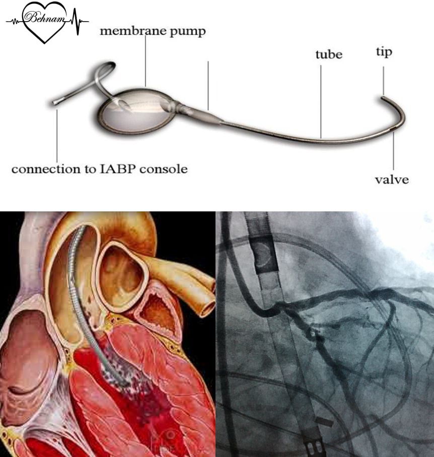 ivac device heart