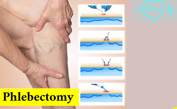Phlebectomy