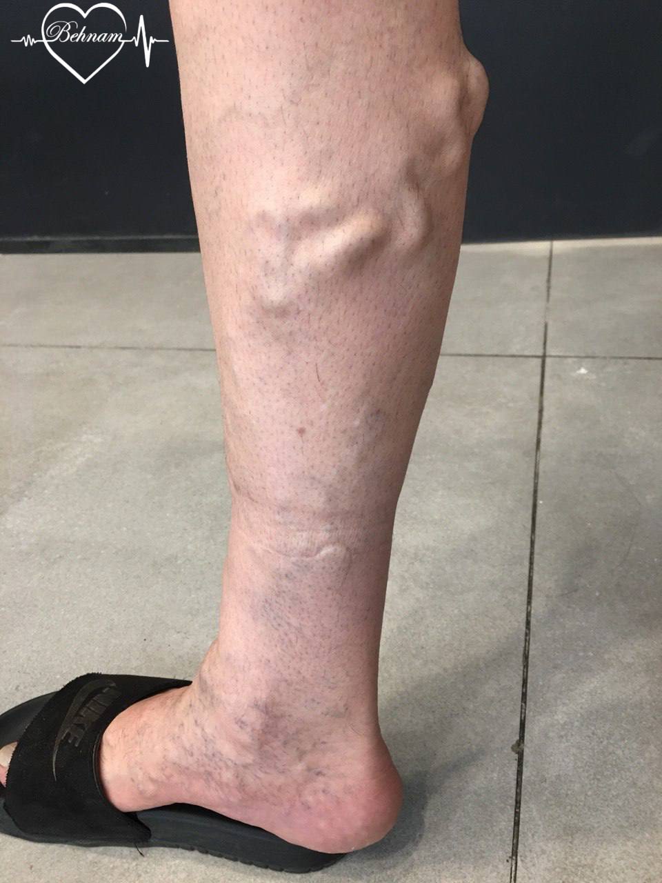 calfvaricoseveins