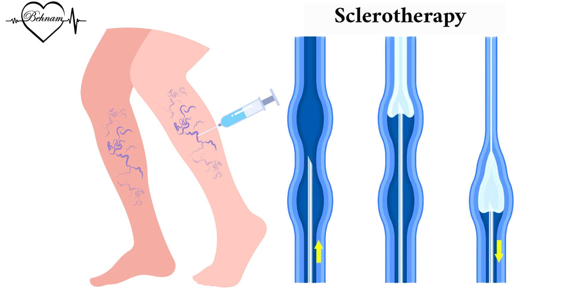 sclerotherapy