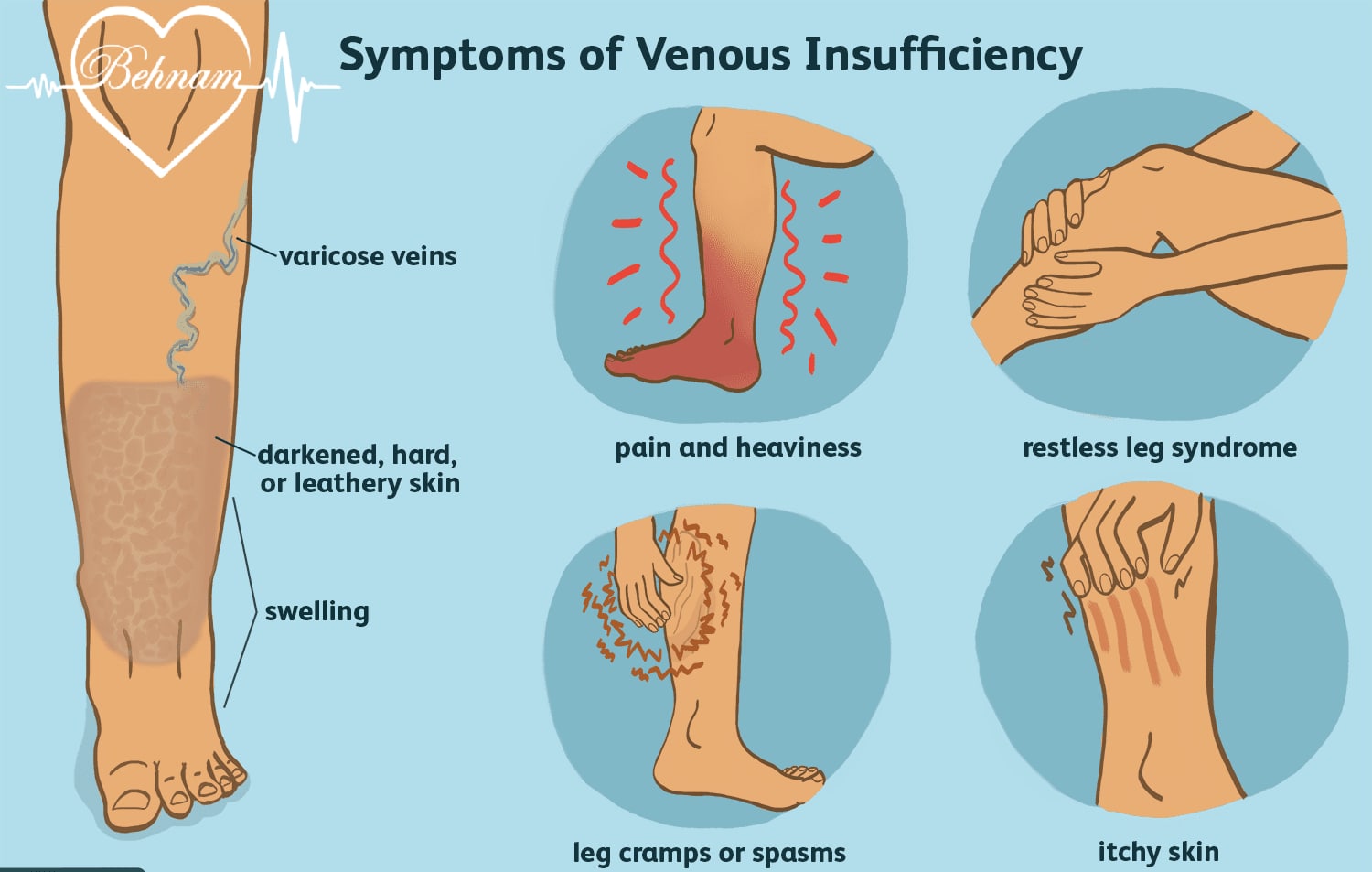 signs and symptoms of varicose veins