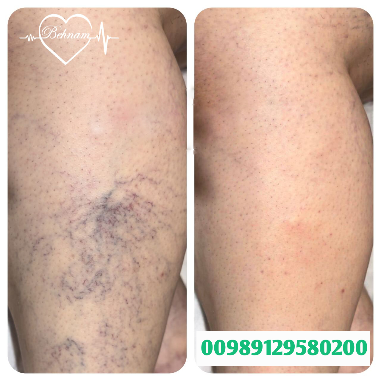 spidervaricoseveins