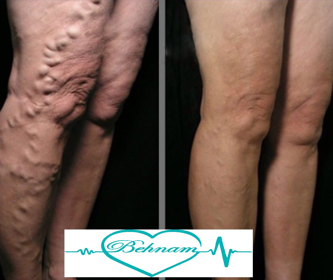 trunkvaricoseveins