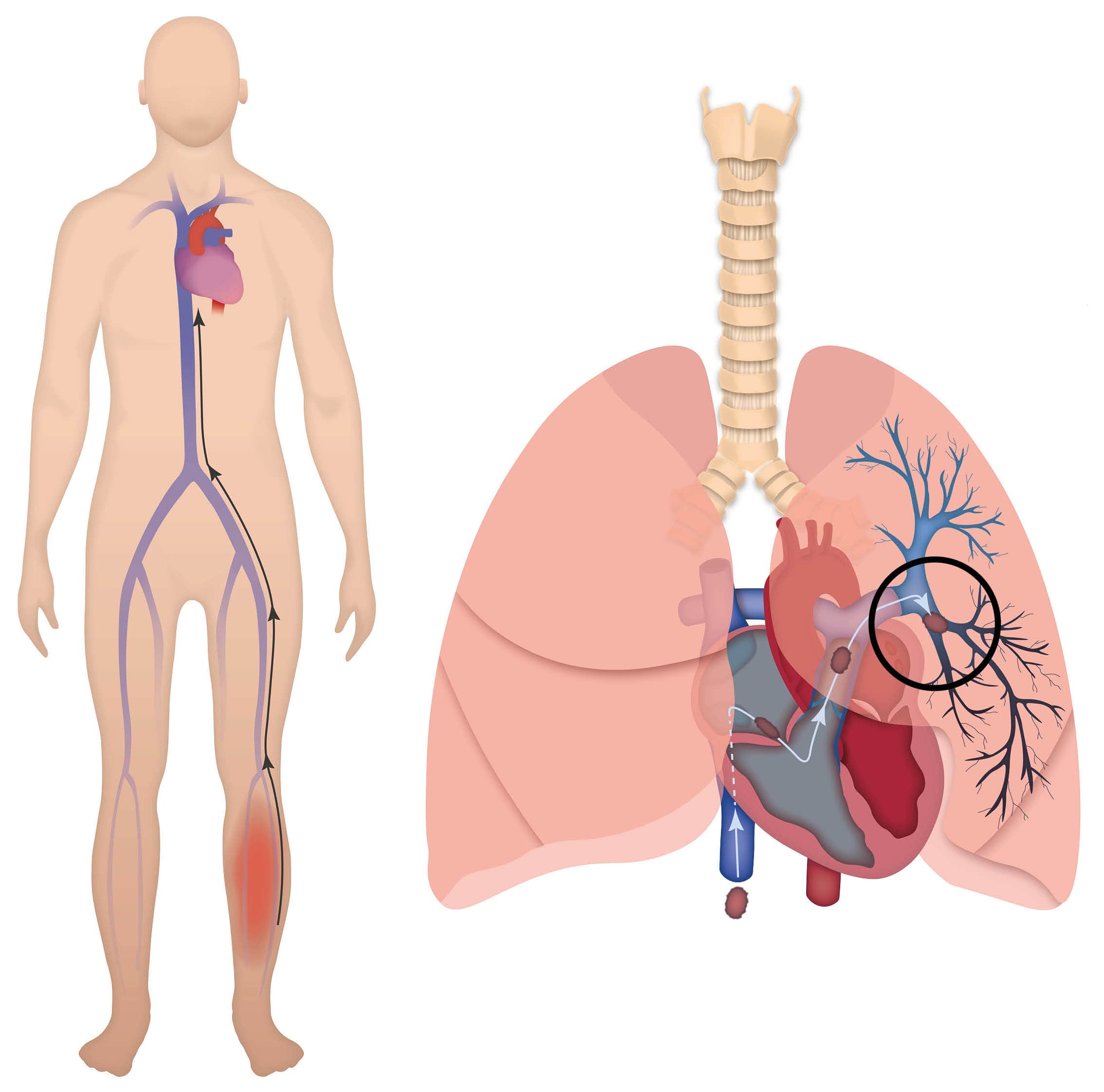 varicose veins and pulmonary embolism