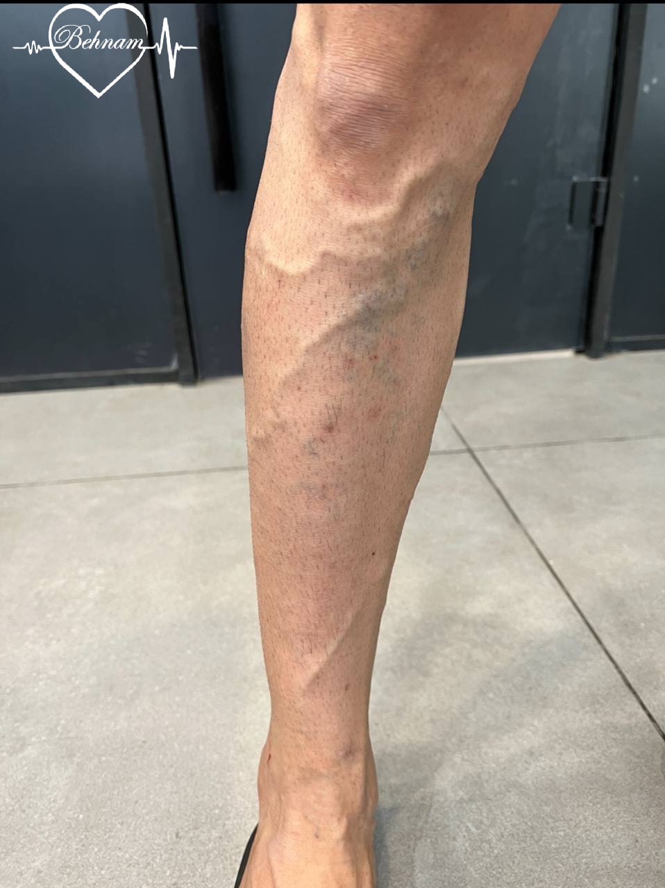 kneevaricoseveins