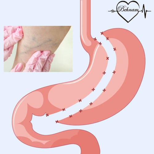 varicose veins and gastric sleeve surgery